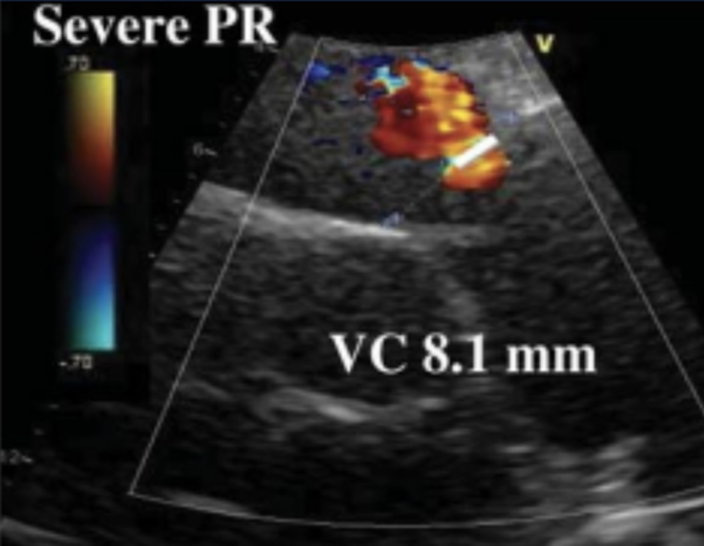 <p>Measure in PSAX</p><p>Must see flow convergence, neck, and PR jet</p>