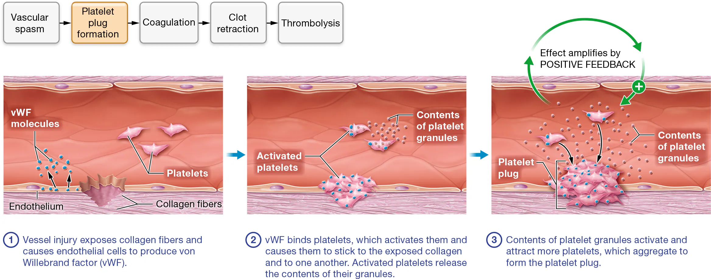 <p><strong><em>normally</em></strong>, platelets are not sticky, however platelets do adhere to an injured site.</p><p></p><p><strong><em>when a vessel is injured</em></strong>,&nbsp;</p><ol><li><p>collagen fibers and chemicals in the vessel’s tunica adventitia are exposed.</p></li><li><p>The injured endothelial cells release a glycoprotein called <strong><em>von Willebrand factor</em></strong> (fahn VIL-uh-brant), or <strong>vWF</strong></p></li><li><p>vWF binds to the receptors on the surface of platelets’ plasma membranes</p></li></ol><p></p><p>Together, the exposed collagen and vWF make the platelets sticky so they adhere to one another and the vessel wall</p><p></p><ol start="4"><li><p>Platelet activation: Activated platelets release the contents of their granules— ATP, ADP, serotonin, calcium ions, clotting factors, and other chemicals—by exocytosis.</p></li></ol><p></p><ol start="5"><li><p>This effect amplifies through a<strong><em> positive feedback loop</em></strong>, as many of these factors attract and activate nearby platelets, which in turn release the contents of their granules and attract additional platelets. </p></li></ol><p></p><ol start="6"><li><p>The platelets drawn to the wound clump together, or <strong>aggregate</strong>, which forms the platelet plug.</p></li></ol><p></p><p><strong><em>This plug is short lived without something to glue it together</em></strong></p>