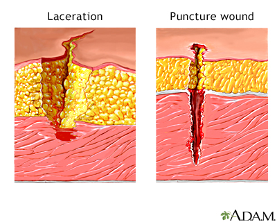 <p>PP: damage penetrating under the skin</p><p>E:<br><u>laceration:</u><br>tearing of soft body tissue<br>irregular+jagged<br>often contaminated</p><p><u>puncture:</u><br>sharp pointy object (nail/teeth/etc.)<br>prone to infection</p><p>TX: stop bleeding<br>clean sutures</p>