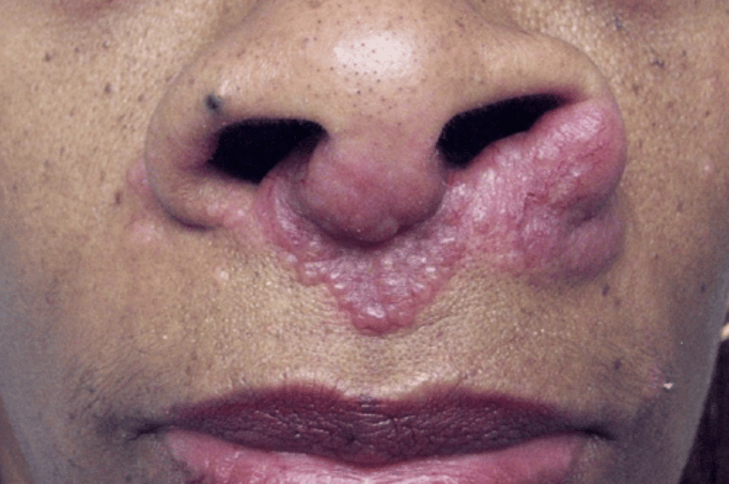 <p>- violaceous, raised discoloration of nose/ear/cheek/chin</p><p>- resembles frostbite</p><p>- pathognomonic for sarcoidosis</p>