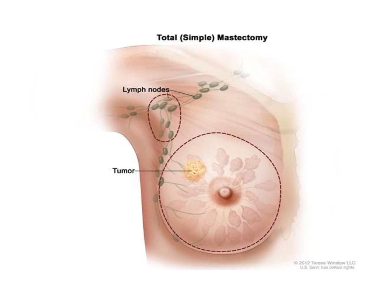 <p>removal of the <strong>entire breast</strong>, but <strong>no lymph nodes</strong> and <strong>no muscle</strong> removed.</p>