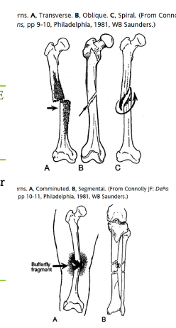 <p>1) Fracture à basse énergie (Ligne de fracture)</p><ul><li><p>Transverse </p></li><li><p>Oblique</p></li><li><p>Spiral</p></li></ul><p>2) Fracture à haute énergie (Nbr de fragment)</p><ul><li><p>Comminutive</p></li><li><p>Segmental</p></li><li><p>Stress</p></li></ul>