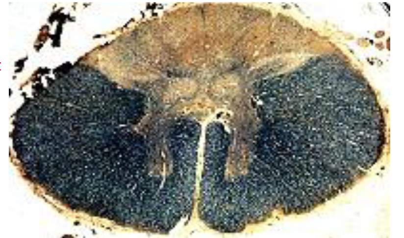 <p>An effect of syphillis. The dorsal column cells die off. Disrupts sensation of fine touch vibration, two-point tactile, stereognosis, and proprioception.</p>