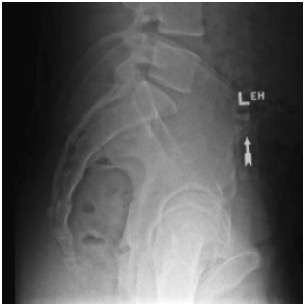 <p>On a MV riight lateral image, what bony anatomy can be used to assist with the match</p>