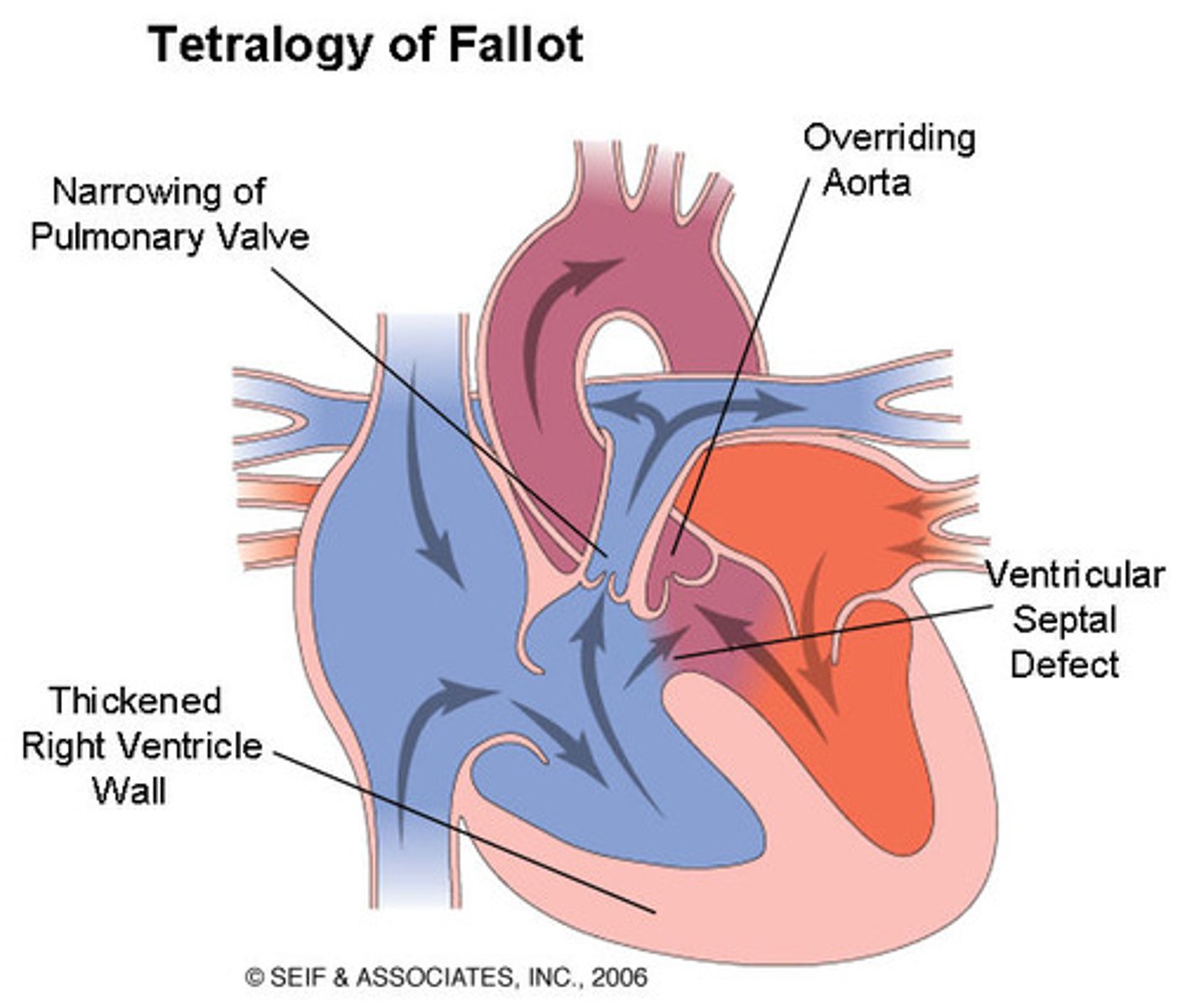 <p>1. Ventricular Septal Defect (VSD) — large opening between ventricles</p><p>2. Pulmonary Artery/Valve Stenosis — narrowing forces RV to work harder</p><p>3. Overriding Aorta — aorta sits directly OVER the VSD, receiving blood from BOTH ventricles → purple (mixed) blood exits</p><p>4. Right Ventricular Hypertrophy (RVH) — develops over time from RV working against narrowed PA; makes chamber smaller and creates dysrhythmia risk</p><p>TOF has pulmonary stenosis, VSD, overriding aorta, and RV hypertrophy; the RV outflow obstruction limits blood going to the lungs and drives a right‑to‑left shunt, so deoxygenated blood reaches the body.</p>