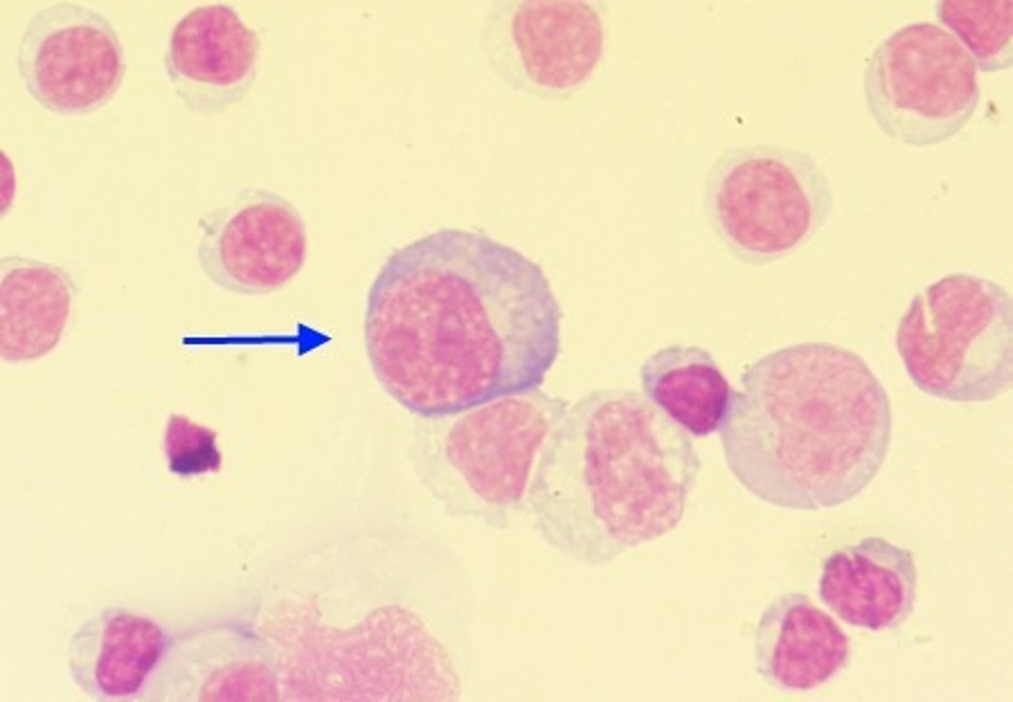 <p>A patient with an infectious mononucleosis infection presents in the emergency room. Physicians order a spinal tap which is immediately sent to the laboratory for review. Please identify the cell in the image below from this patient's cerebrospinal fluid sample.</p><p>A. Reactive Lymphocyte</p><p>B. Monocyte</p><p>C. Macrophage</p><p>D. Mesothelial Cell</p>