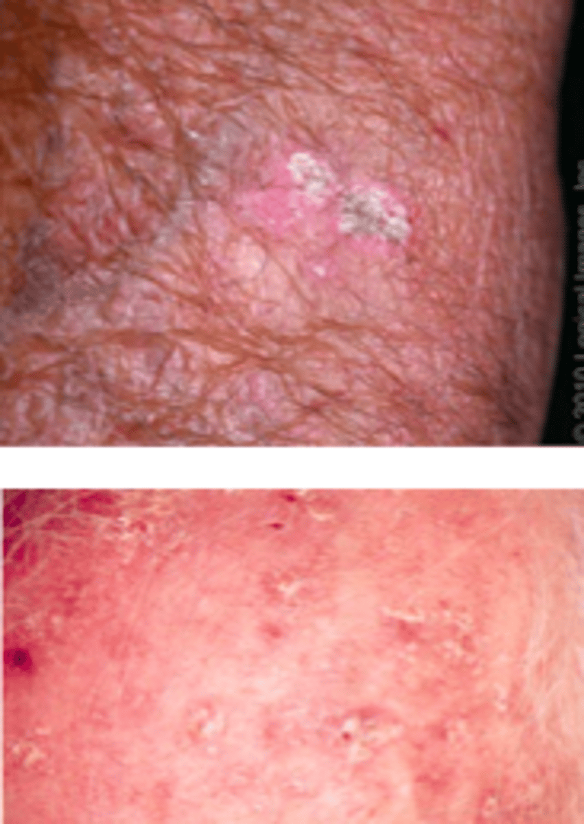 <p>Keratotic Disorders:</p><p>Overview:</p><p>- Cutaneous lesion that results from proliferation of epidermal keratinocytes</p><p>- Present as erythematous and scaly macules/papules</p><p>Risk factors: chronic sun exposure (frequently sun-exposed areas), history of sunburn</p><p>- Most common reasons for visits to dermatologists!</p><p>This is a risk factor for the development of cutaneous squamous cell carcinoma (SCC)</p>