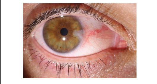 <p>What condition is shown and will this impact their ability to wear contact lenses? 2 marks</p><p>Would you recommend any specific contact lens or contact lens feature to this person and why? 2 marks</p>