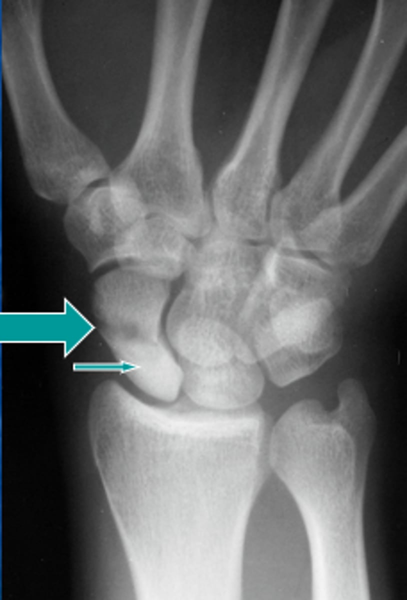 <p>Proximal mid and distal poles are sclerotic</p>