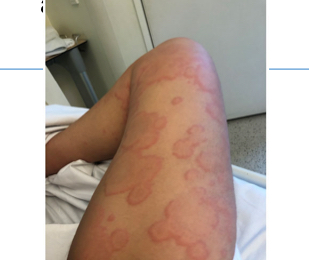 <p>symptoms of acute serum sickness</p>