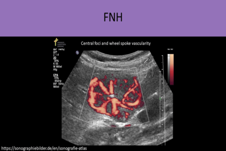 <p>1. VARIABLE, can be ISOECHOIC TO LIVER<br>2. "STEALTH LESION" because it's difficult to differentiate from liver tissue<br>3. SOLITARY, LESS THAN 5 CM<br>4. CENTRAL SCAR with RADIAL VASCULARITY<br>5. looks like SPOKES ON A WHEEL (vascularity starts at a central location and branches radially)<br>6. mass may DISTORT LIVER SURFACE CONTOUR or may DISPLACE NORMAL BLOOD VESSELS<br>7. NOT ABLE TO DIAGNOSE ON US ALONE</p>