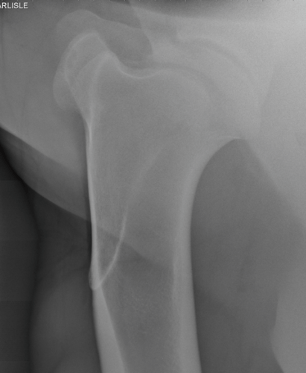 <p>What structures are highlighted by a cranial 45 medial-caudolateral view?</p>