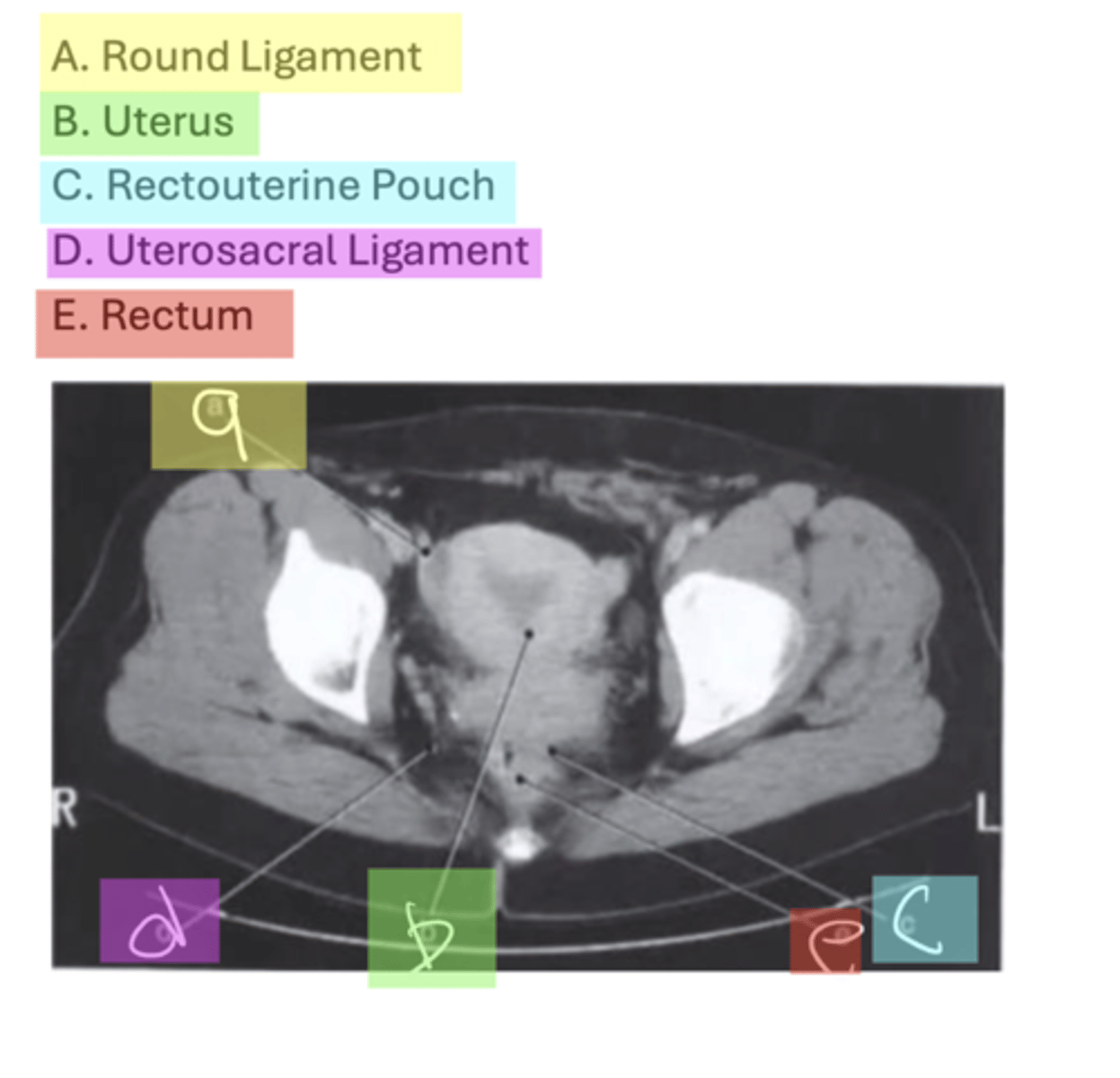 <p>A. Round Ligament</p><p>B. Uterus</p><p>C. Rectouterine Pouch</p><p>D. Uterosacral Ligament</p><p>E. Rectum</p>