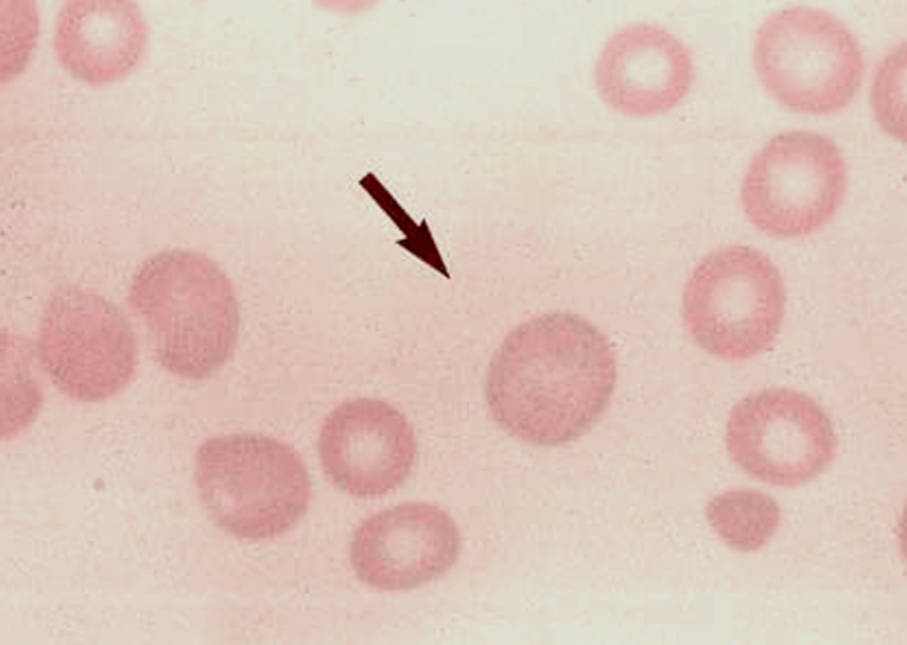 <p>more than considered normal</p><p>stain differently than mature rbcs</p>