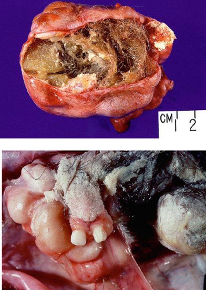 <p>tumor of all 3 germ layers</p>