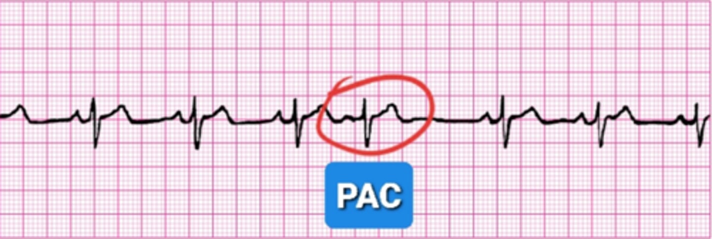 <p>Atrial ectopy (not a rhythm) similar to an ill timed hiccup within the atria, or the atria playing a game of interrupting cow.</p>