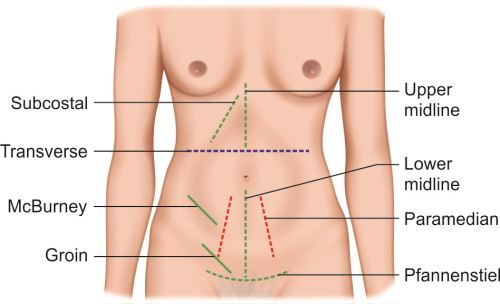 <p>C. subcostal flank</p>