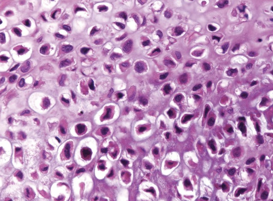 <p><span>Describe the gross appearance.</span></p><p style="text-align: left;"><span>What is the cell of origin?</span></p><p style="text-align: left;"><span>What is the diagnosis?</span></p><p style="text-align: left;"><span>What is the malignant counterpart called?</span></p>