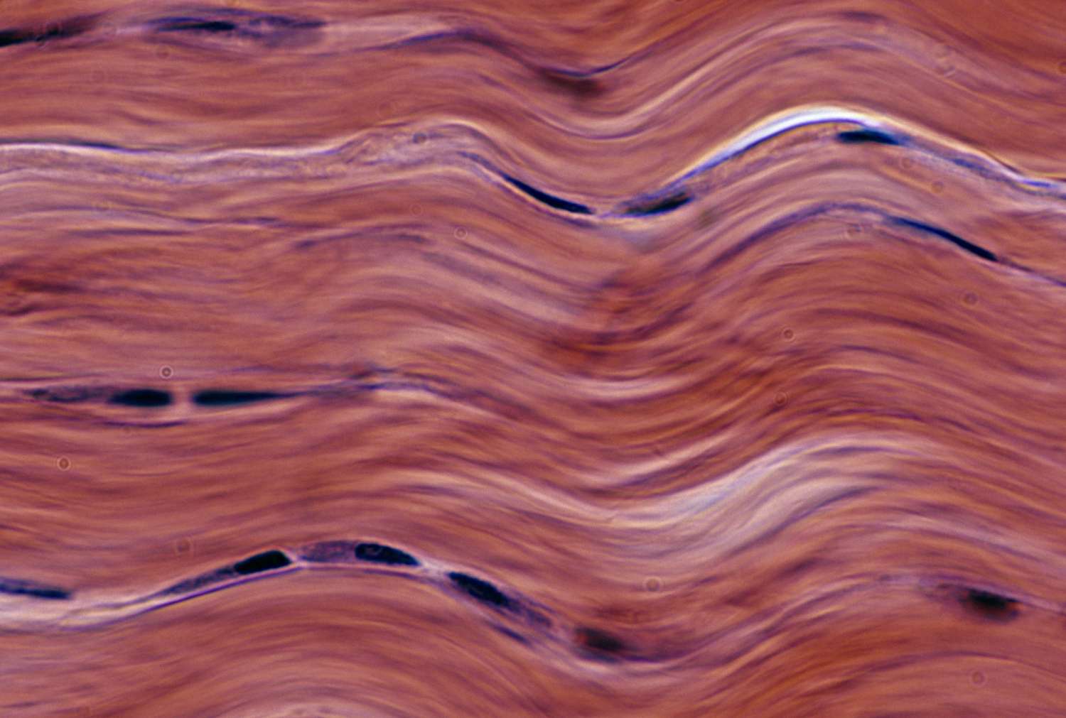 dense fibrous 
