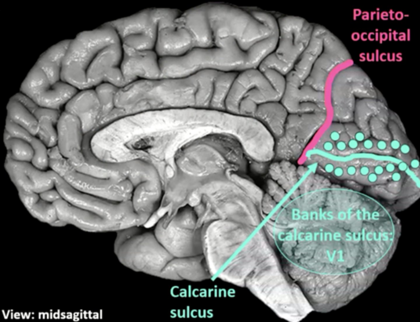 <p>cortical region:</p><p>calcarine sulcus</p><p>cerebral lobe: occipital (V1)</p>
