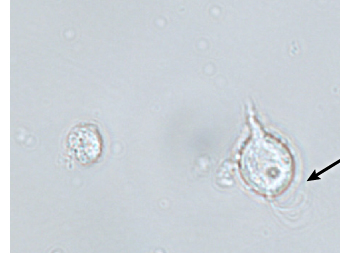 <p>vulvovaginal pruritis &amp; malodorous, green discharge</p>