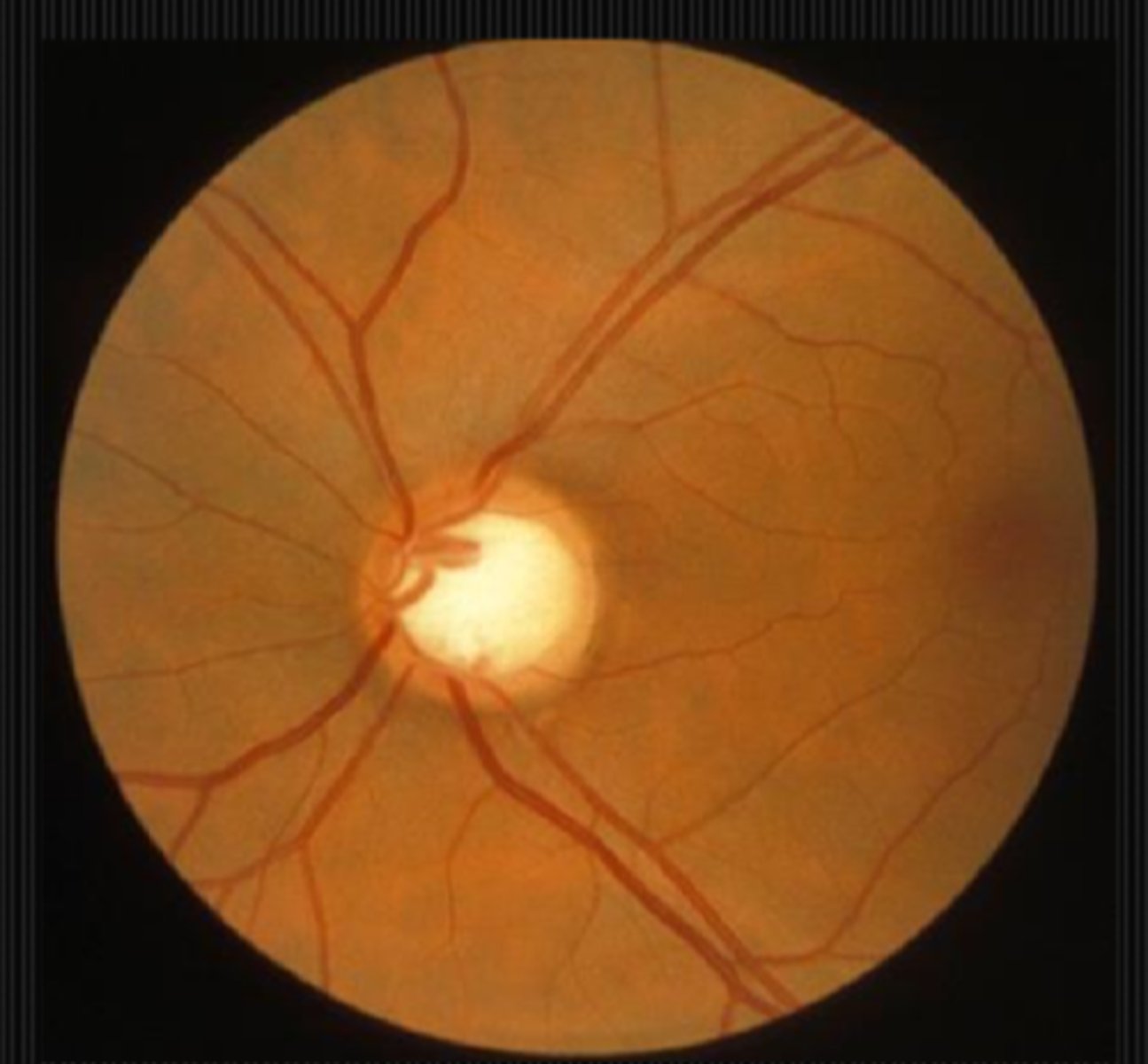 <p>other than the obvious, glaucoma...</p><p>trauma</p><p>ischemia</p><p>compression</p><p>inflam</p>