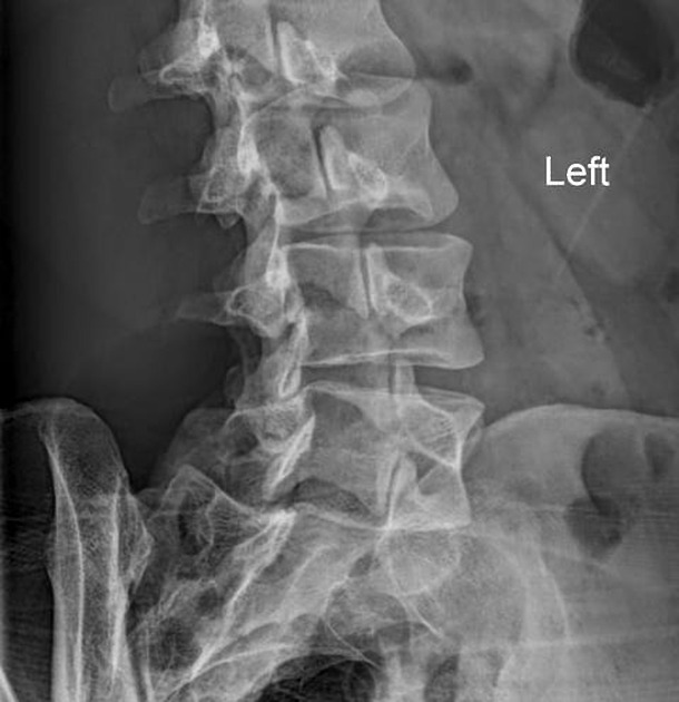 <p>Define this pathology and its radiographic appearance and symptoms that patients may present</p>