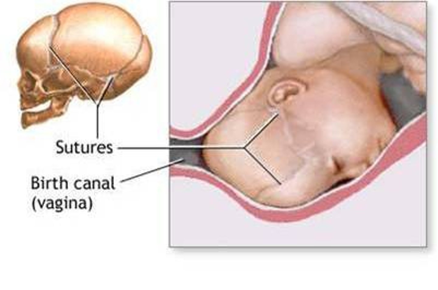 <p>temp overlapping of fetal skull bones, moulded during labour to help fit through birth canal</p>