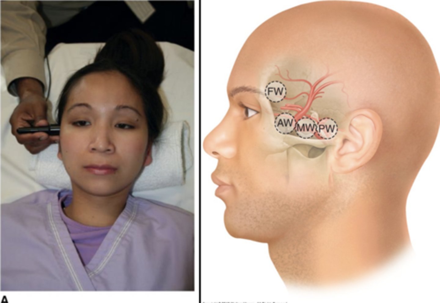 <p>Over temporal bone</p><p>Frontal, middle, anterior, and posterior windows</p>