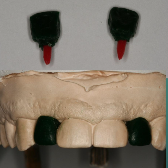 <p>What is the second step to fabricating a provisional implant restoration?</p>