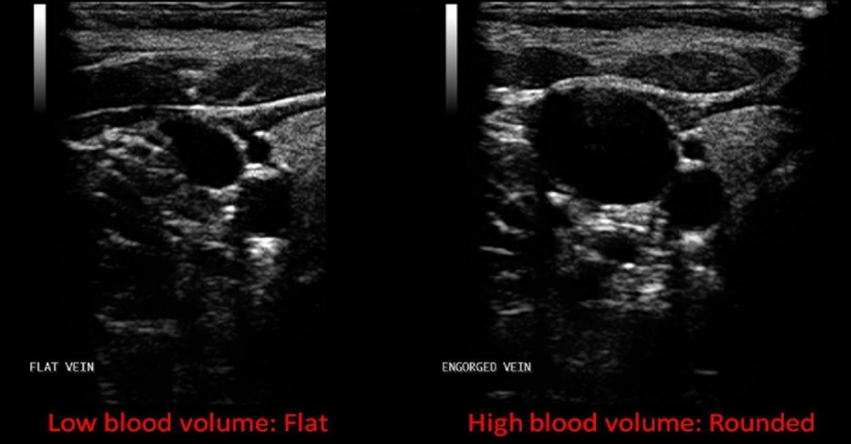 <p>When transmural pressure is low or there is a low blood volume </p>