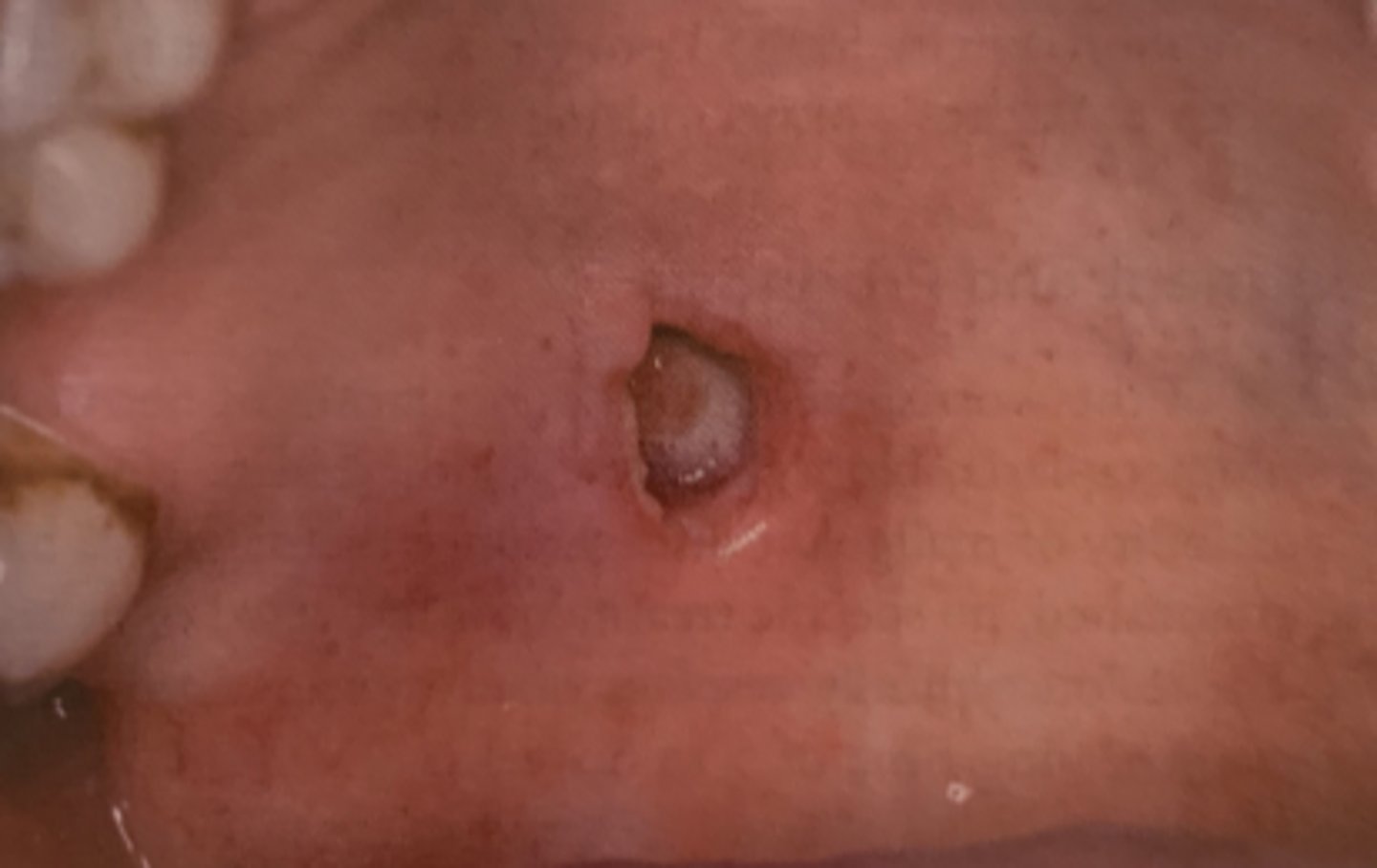 <p>PAINFUL swelling</p><p>• associated with decreased blood supply (trauma, injection, CD)</p><p>• common location: hard palate</p>