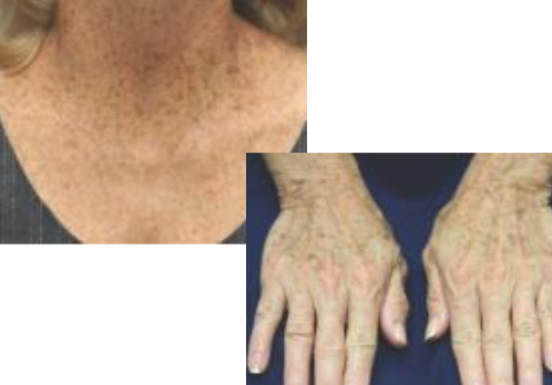 <p>bilaterally symmetric, brown macules on sun-exposed skin</p>