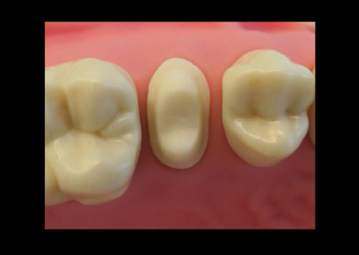 <p>Today, the 4 PFM has a chamfer margin on the</p>