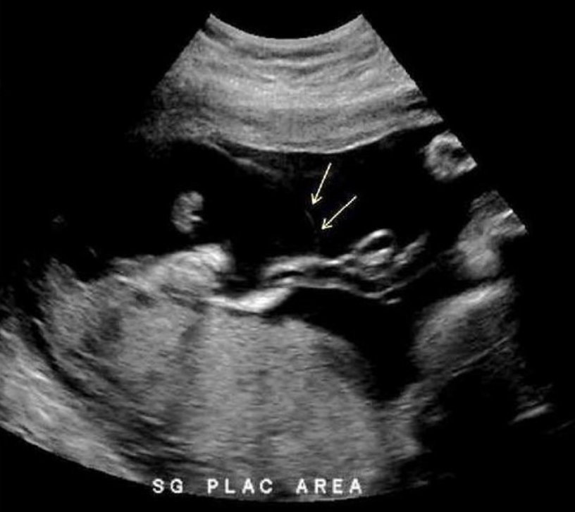 <p>a) umbilical cord cyst</p><p>b) placental abruption</p><p>c) chorioangioma</p><p>d) vasa previa </p>