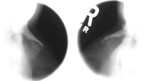 <p>What is this x-ray demonstrating?</p>