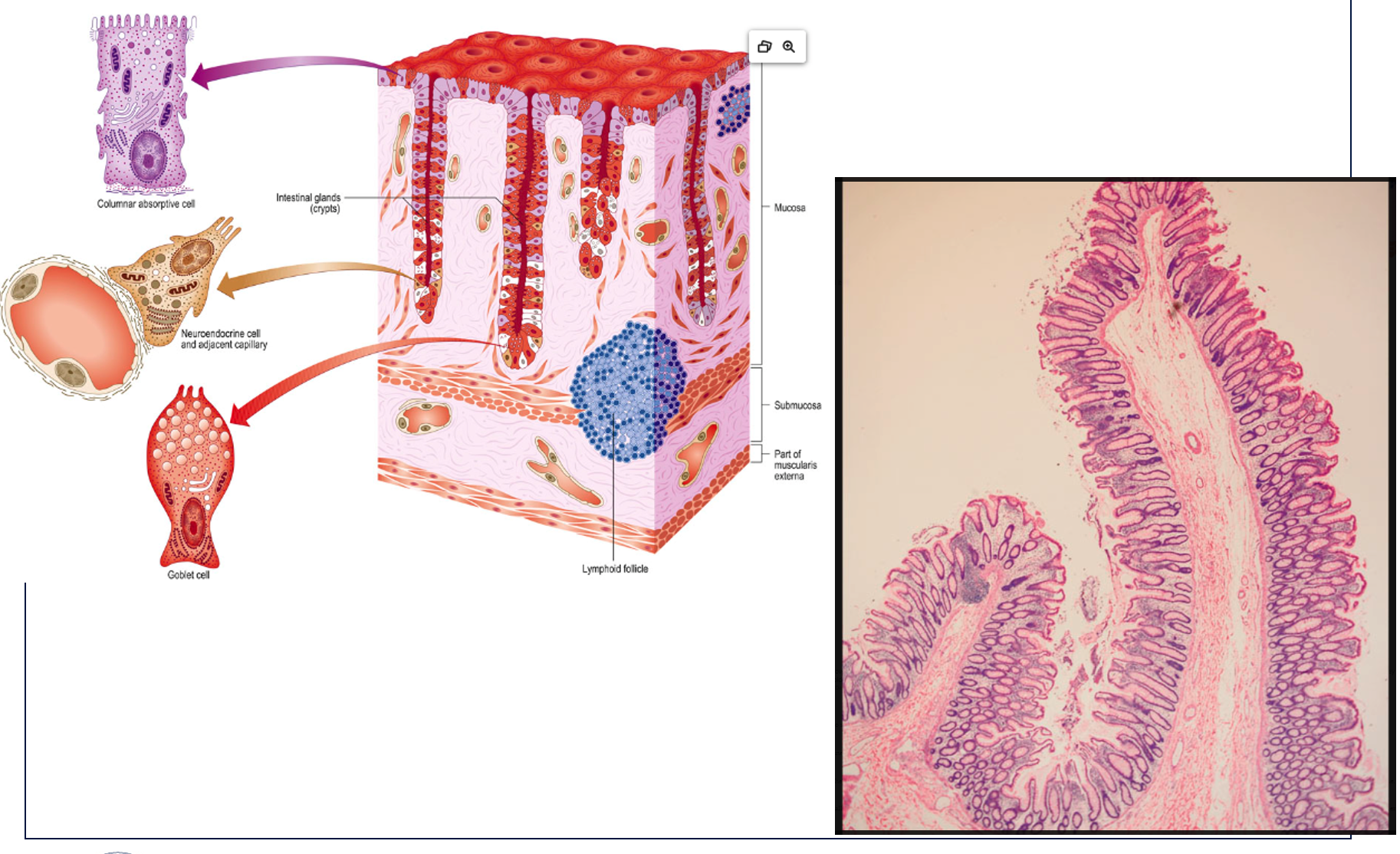 <p><strong>About the Diagram (Left Panel):</strong></p><ol><li><p><strong>What are the main layers of the intestinal wall shown in the diagram?</strong> The main layers of the intestinal wall shown are the Mucosa, Submucosa, and a "Part of muscularis externa".</p></li><li><p><strong>What specific structures are found within the Mucosa layer?</strong> Within the Mucosa layer, we can see Intestinal glands (or crypts), and various cell types lining them, including Columnar absorptive cells and Goblet cells. The diagram also indicates Neuroendocrine cells and an adjacent capillary within the gland.</p></li><li><p><strong>What are the characteristic invaginations of the intestinal lining called?</strong> The characteristic invaginations of the intestinal lining are called Intestinal glands, also known as crypts of Lieberkühn.</p></li><li><p><strong>Identify the different cell types depicted in the intestinal glands.</strong> The different cell types depicted are Columnar absorptive cells, Neuroendocrine cells (with an adjacent capillary), and Goblet cells.</p></li><li><p><strong>What is the primary function of the "Columnar absorptive cell" in this region?</strong> The primary function of the Columnar absorptive cell in the large intestine is the absorption of water and electrolytes.</p></li><li><p><strong>What is the primary function of the "Goblet cell" and what does it secrete?</strong> The primary function of the Goblet cell is to produce and secrete mucus. This mucus lubricates the passage of fecal material and protects the intestinal lining.</p></li><li><p><strong>Where are "Neuroendocrine cells" located and what is their general role?</strong> Neuroendocrine cells are located within the intestinal glands. Their general role is to secrete hormones and signaling molecules that regulate various digestive functions, such as gut motility and secretion, in response to luminal contents.</p></li><li><p><strong>What is the significance of the "Lymphoid follicle" in the submucosa?</strong> The Lymphoid follicle in the submucosa is part of the gut-associated lymphoid tissue (GALT). Its significance lies in its role in immune surveillance and defense against pathogens entering the digestive tract.</p></li><li><p><strong>What is the role of the "Part of muscularis externa" shown in the diagram?</strong> The muscularis externa is primarily responsible for the movements of the intestine, including peristalsis (propulsion of contents) and segmentation (mixing of contents).</p></li><li><p><strong>How does the arrangement of cells in the intestinal glands differ from the surface epithelium?</strong> The diagram shows that the surface epithelium is primarily composed of columnar absorptive cells with interspersed goblet cells. The intestinal glands (crypts) are invaginations where goblet cells become more numerous, especially deeper in the crypts, and various specialized cells (like neuroendocrine cells) reside, which are typically less abundant on the surface.</p></li></ol><p><strong>About the Microscopic Image (Right Panel):</strong></p><ol start="11"><li><p><strong>What anatomical structure is likely represented in the microscopic image? (Hint: based on the features shown).</strong> The microscopic image likely represents the <strong>large intestine (colon)</strong>, characterized by its straight, unbranched intestinal glands (crypts) and the lack of villi.</p></li><li><p><strong>Can you identify the crypts (intestinal glands) in the microscopic image?</strong> Yes, the crypts (intestinal glands) are clearly visible as the numerous, long, test-tube-like invaginations extending downwards from the surface epithelium into the lamina propria.</p></li><li><p><strong>What is the prominent cell type visible lining the crypts and surface, and what features help identify it?</strong> The prominent cell type lining the crypts and surface is the <strong>columnar absorptive cell</strong>. It is identified by its tall, columnar shape and often a brush border (though not clearly resolved at this magnification) at its apical surface.</p></li><li><p><strong>What are the clear, vacuolated cells often seen in abundance in this tissue, and what do they represent?</strong> The clear, vacuolated cells, which appear as "empty" spaces within the epithelial lining (especially prominent in the crypts), are <strong>Goblet cells</strong>. Their clear appearance is due to the mucin they contain, which washes out during histological preparation.</p></li><li><p><strong>How does the microscopic image correlate with the structural features shown in the diagram?</strong> The microscopic image strongly correlates with the diagram. The diagram is a simplified, idealized representation, while the micrograph is a real tissue section. Both show the characteristic straight tubular intestinal glands, the columnar epithelial lining, and the presence of goblet cells. The layers of the wall (mucosa, submucosa) are also visible in the micrograph, consistent with the diagram.</p></li></ol><p><strong>Comparative/Integrative Questions:</strong></p><ol start="16"><li><p><strong>How does the histology of this region (colon) differ from that of the small intestine (e.g., presence/absence of villi, abundance of goblet cells)?</strong></p><ul><li><p><strong>Villi:</strong> The colon (large intestine) <strong>lacks villi</strong>, which are prominent finger-like projections found in the small intestine to increase surface area for nutrient absorption. The colon has a relatively flat surface with deep crypts.</p></li><li><p><strong>Goblet cells:</strong> Goblet cells are <strong>much more abundant</strong> in the large intestine compared to the small intestine. This reflects the large intestine's primary role in water absorption and the need for copious mucus to lubricate fecal material.</p></li></ul></li><li><p><strong>What are the key adaptations of this intestinal region for its specific digestive/absorptive functions, as suggested by its histology?</strong> The key adaptations are:</p><ul><li><p><strong>Abundant Goblet Cells:</strong> Provide lubrication for the passage of solidifying fecal material and protection against mechanical abrasion and bacterial action.</p></li><li><p><strong>Deep Intestinal Glands/Crypts:</strong> Provide a large surface area for the specialized cells, particularly those involved in water and electrolyte absorption, and mucus secretion.</p></li><li><p><strong>Prominent Columnar Absorptive Cells (without villi):</strong> Optimized for water and electrolyte absorption, which is the primary absorptive function of the colon, rather than nutrient absorption.</p></li><li><p><strong>Presence of Lymphoid Follicles:</strong> Essential for immune defense against the vast bacterial population in the large intestine.</p></li></ul></li><li><p><strong>How do the various cell types shown contribute to the overall function of the large intestine?</strong></p><ul><li><p><strong>Columnar Absorptive Cells:</strong> Are responsible for the primary function of the large intestine: absorbing water and electrolytes, leading to the formation of solid feces.</p></li><li><p><strong>Goblet Cells:</strong> Secrete mucus, which lubricates the intestinal contents, protects the epithelium from friction, and aids in bacterial binding and elimination.</p></li><li><p><strong>Neuroendocrine Cells:</strong> Secrete hormones that regulate colonic motility and secretion, ensuring proper transit time and absorption.</p></li><li><p>The <strong>lymphoid follicles</strong> provide immune protection against the dense microbial flora of the large intestine.</p></li></ul></li></ol><p></p>