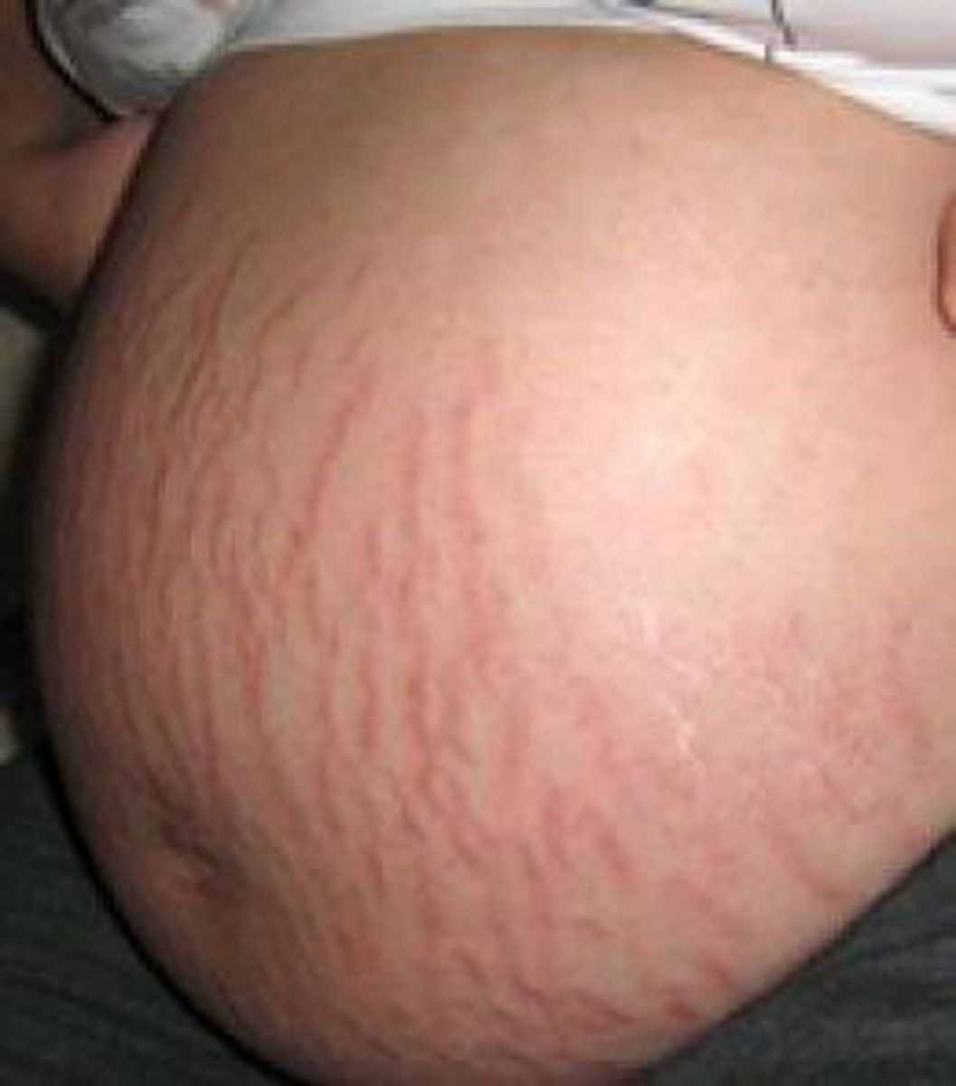 <p>Stretch Marks</p>