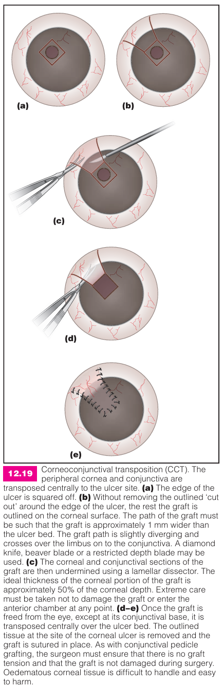 <p>A corneal transplant using adjacent healthy corneal tissue and conjunctival tissue to cover the ulcer and provide structural support.</p>