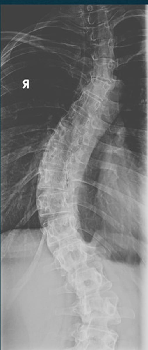 <p>What type of scoliosis is this?</p>