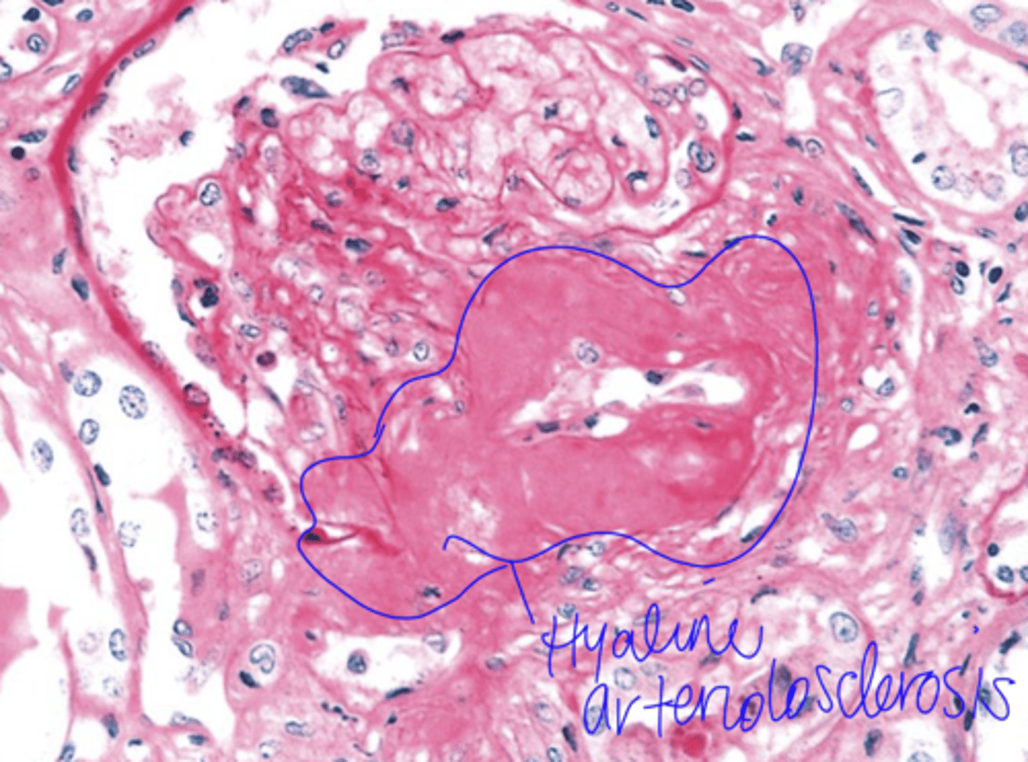 <p>hyaline arteriosclerosis</p>