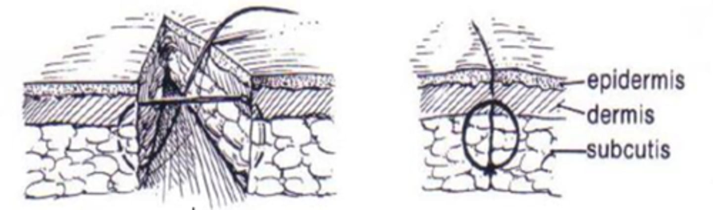 <p>absorbable suture material, appositional, closes dead space, skin sutures support this layer of closure, knot is always at deepest layer</p>