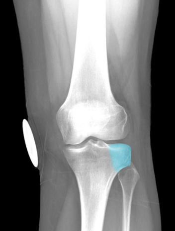 Lateral condyle of tibia more prominent
than medial
Latin: condyle = knuckle