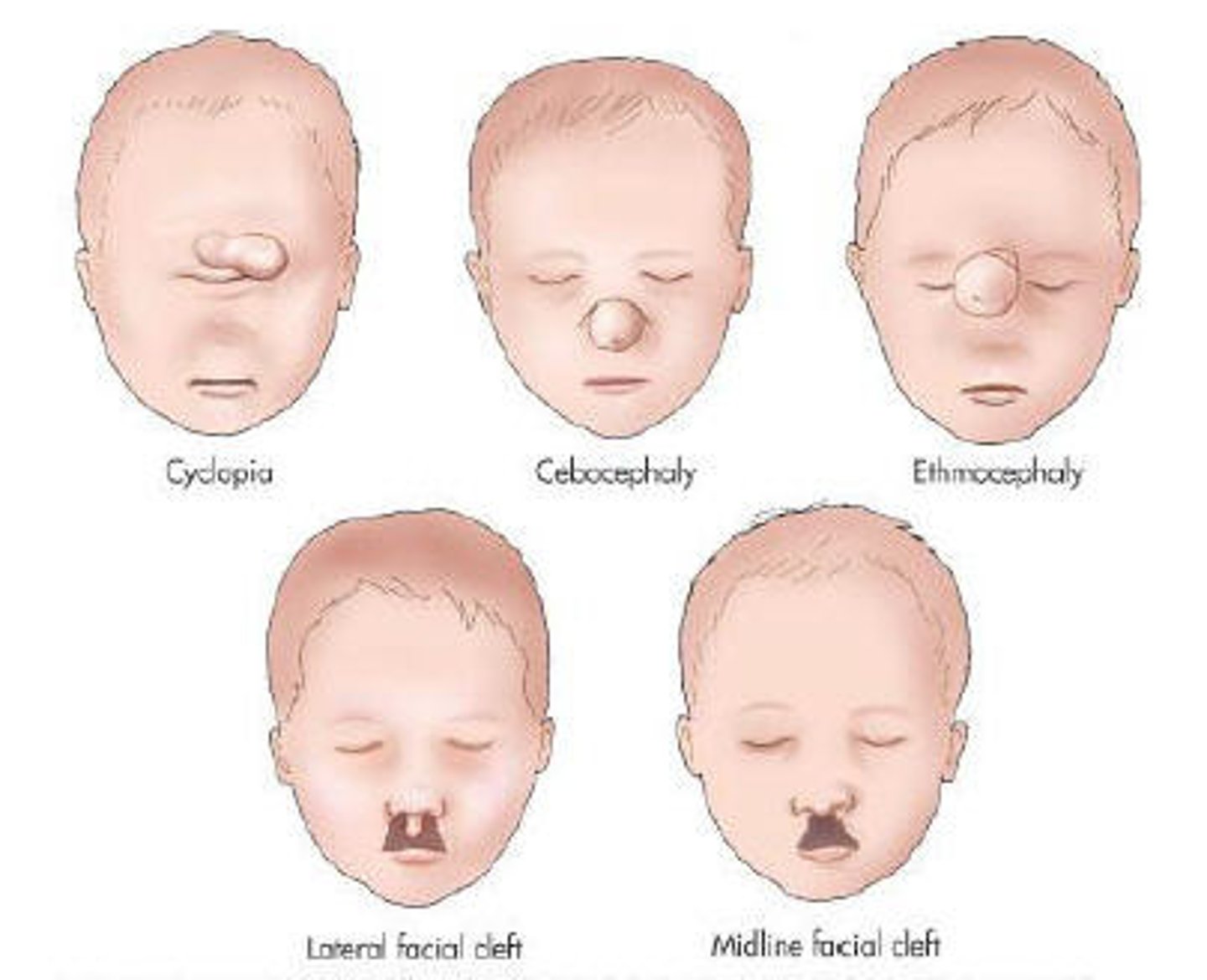 <p>Define Holoprosencephaly</p>