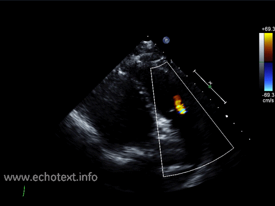 <p>Pulmonic regurgitation (backward flow of blood into the right ventricle).</p>