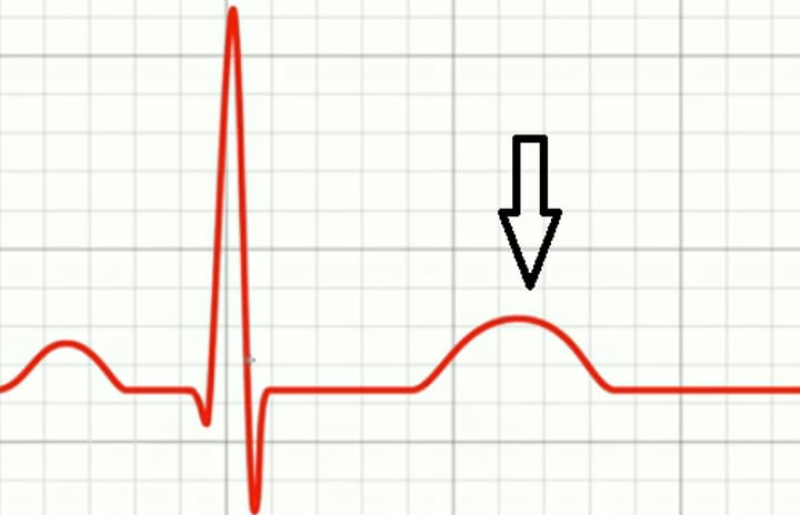 <p>Diastole; relaxing; when myocytes calm down and relax that part of the heart</p>