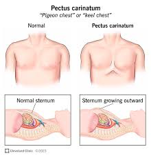 <p>sternum sticks out→increased AP diameter</p><p>depressed costal cartilage adjacent to protruding sternum</p>
