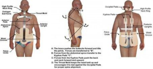 <p><strong>Milwaukee brace</strong></p><ul><li><p>A CTLSO originally designed to help maintain post-operative correction in patients with scoliosis secondary to polio.</p></li><li><p>The pelvic portion helps reduce lordosis, de-rotates the spine, and corrects the frontal deformity.</p></li><li><p>As a child grows, the brace length can be adjusted. Pads can be changed to compensate for spinal growth BUT, the brace needs to be changed if pelvic size increases.</p></li></ul><p></p>