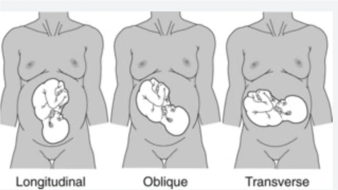 <ul><li><p>Relation of long axis of fetus to long axis of mother</p><ul><li><p>90%: longitudinal </p></li></ul></li></ul><p></p><p></p>