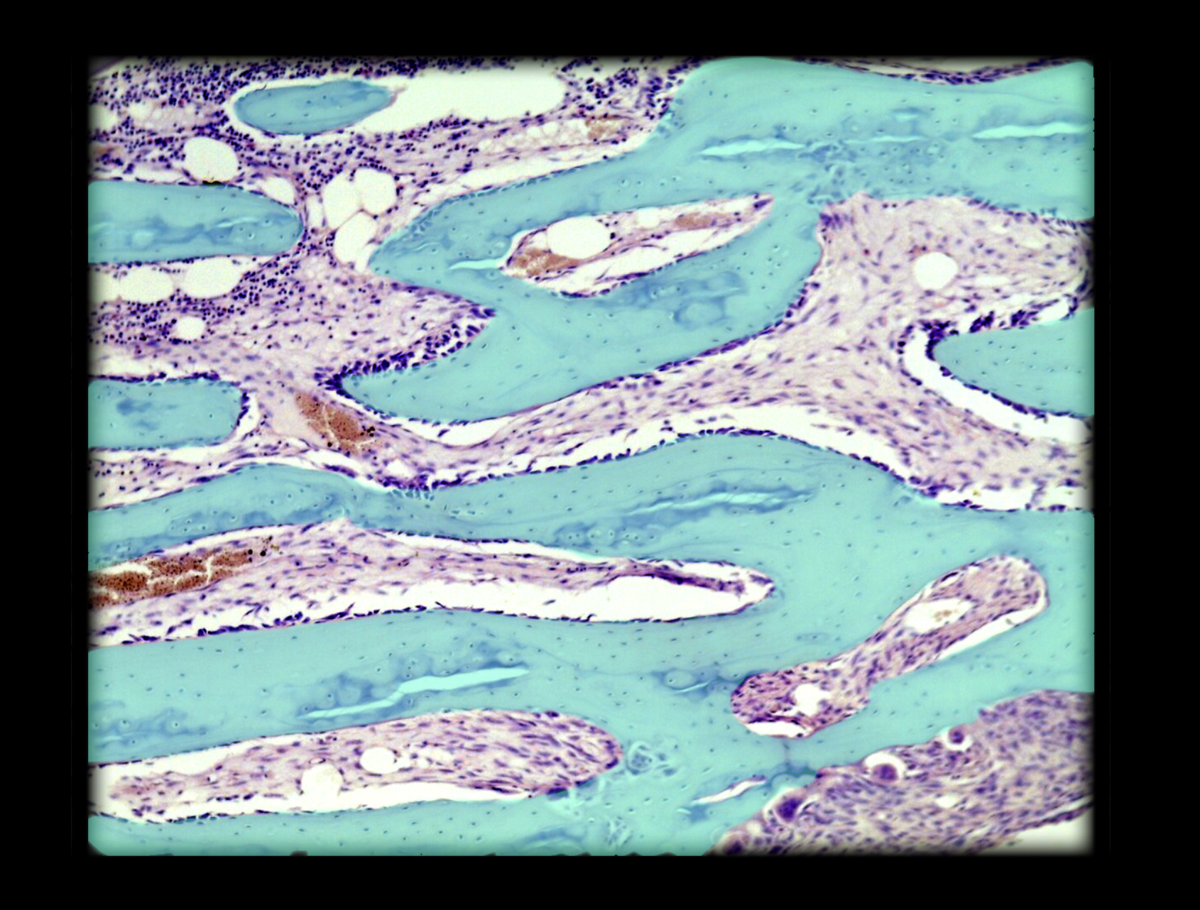 <p>Trabecula of spongy bone</p>